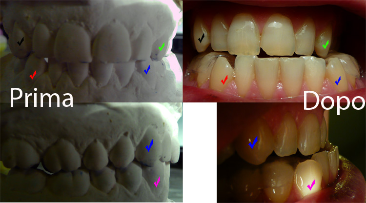 comparazione-occlusione.jpg